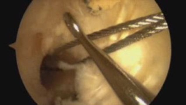 Reconstruction du ligament croisé antérieur technique DIDT