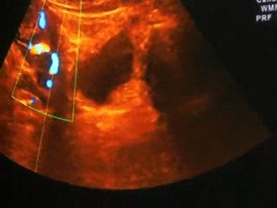 Echographie suite