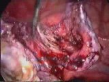 Chocolate Cyst By Dr. Mohamed Ibrahim ALEXEA