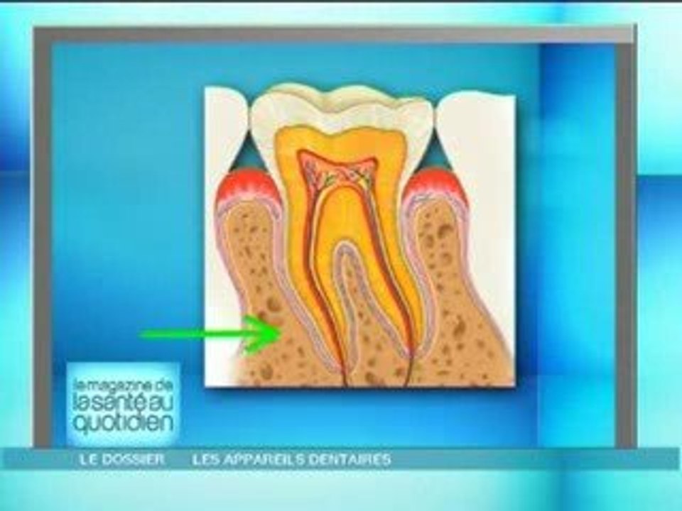 appareils dentaires anatomie