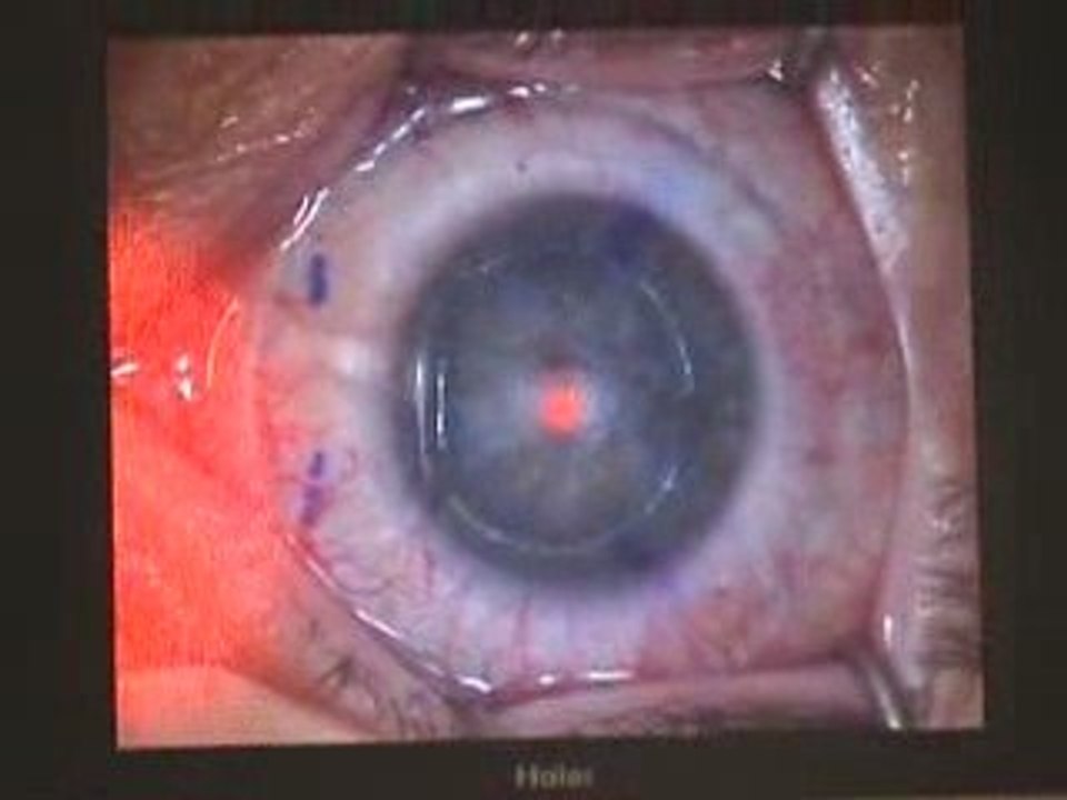 lasik