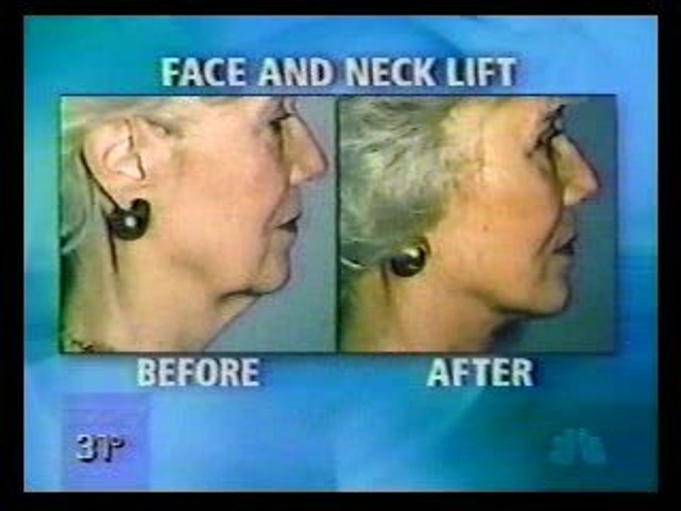 Dr. Darrick Antell speaks with NBC on plastic surgery